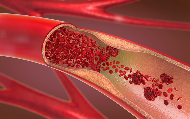 Arteriosclerosis