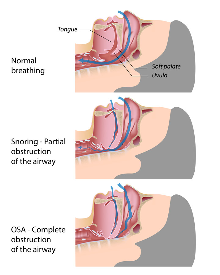 Exercises to Help Obstructive Sleep Apnea